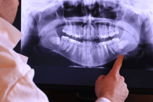 Best Emergency Wisdom Teeth Removal in Coventry Lake, CT
